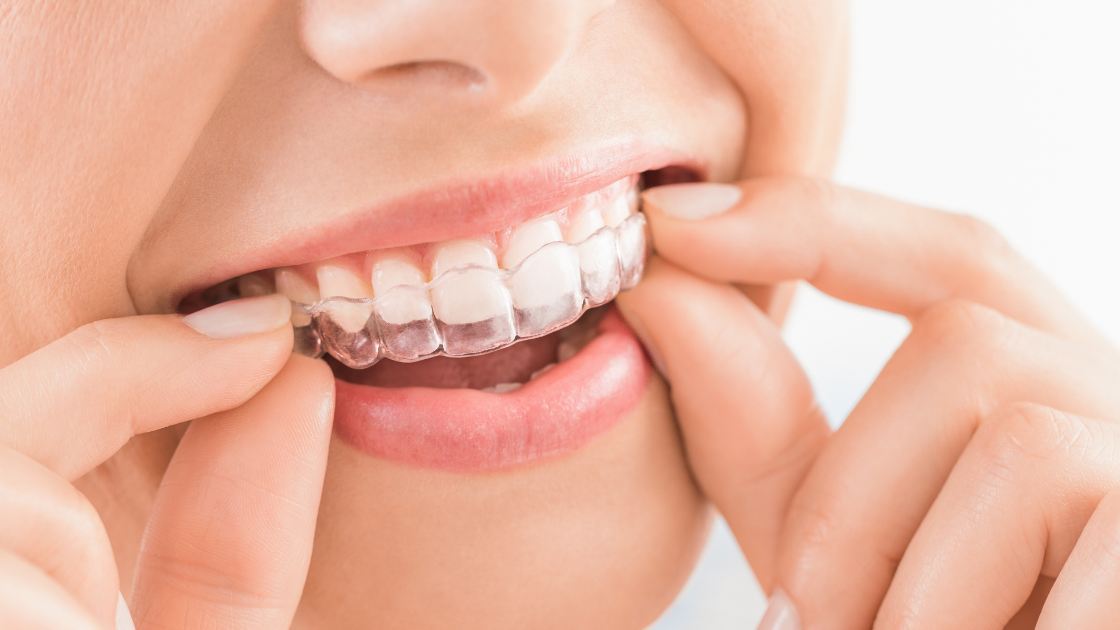 smiles orthodontics, dentist in Lower Lonsdale, North Vancouver BC